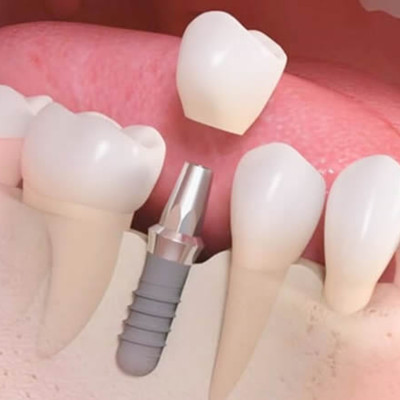 Periodoncia e Implantología Oral