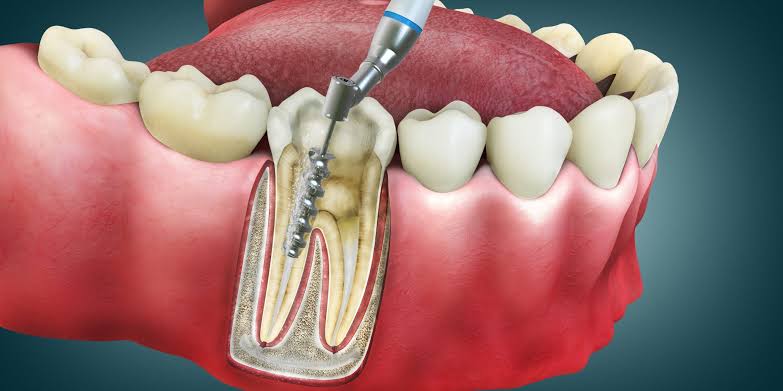 Endodoncia